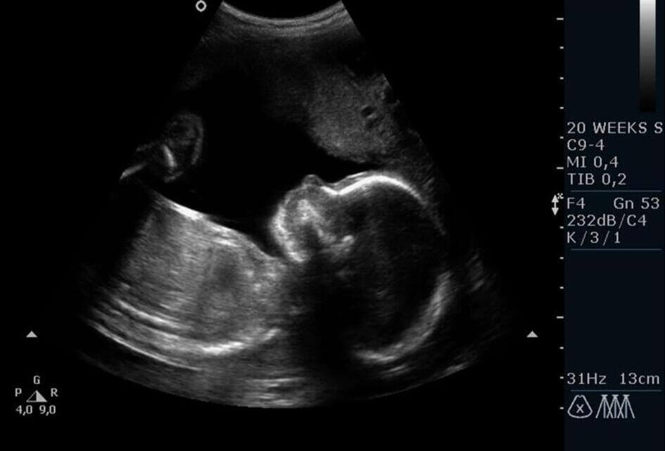 Van Dijk over beraadtermijn abortus