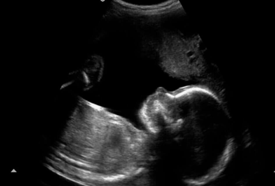 Van Dijk over de abortuspil bij de huisarts